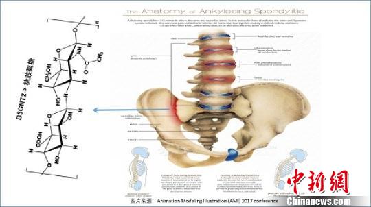 中國科學家等揭示漢族人群強直性脊柱炎關聯基因